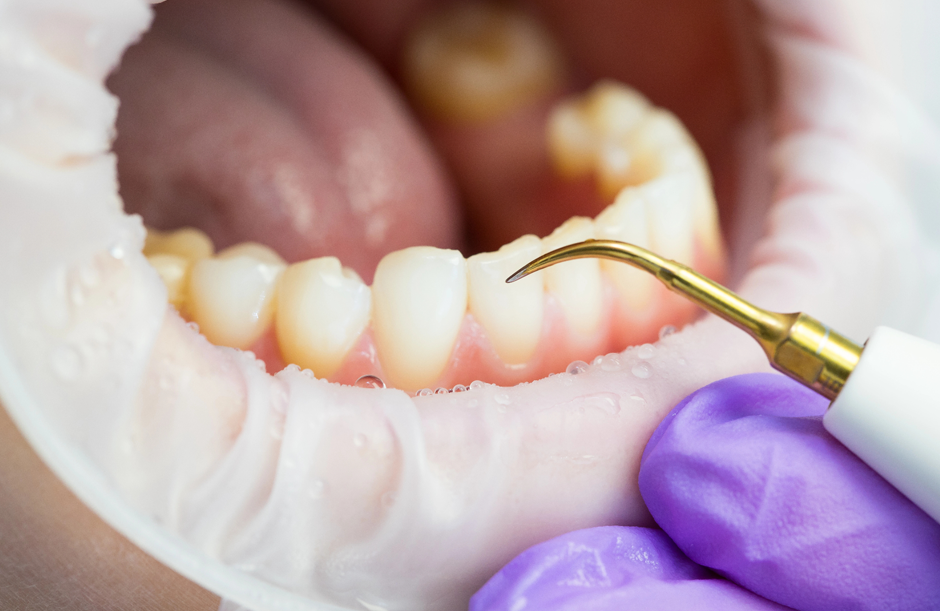 Dentiste réalisant un détartrage sur un patient