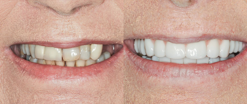 Réhabilitation prothétique